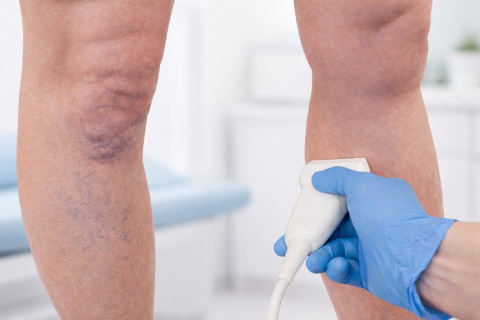 Как образ жизни влияет на здоровье вен