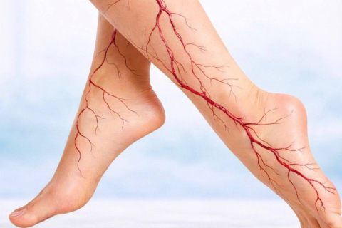 Можно ли остановить варикоз на ранней стадии